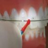 Arch Wire Markers