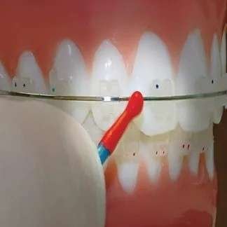 Arch Wire Markers