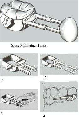 Band Space Maintainer Kit