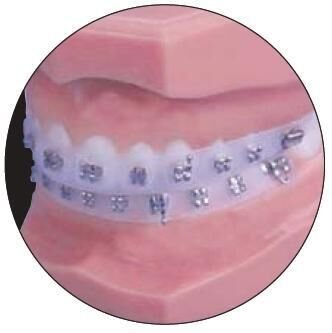 Impression Guards - Dentsply Sirona