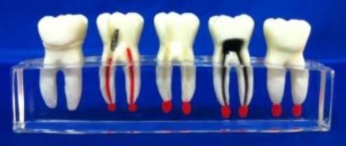 Over-Size Molar Study Model