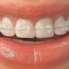 Pure Sapphire Bracket System