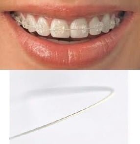 Tooth-Tone-Coated-Nickel-Titanium-Archwire.jpg Tooth Tone Coated Stainless-Steel Archwire