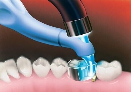 Trimax Composite Instrument - AdDent